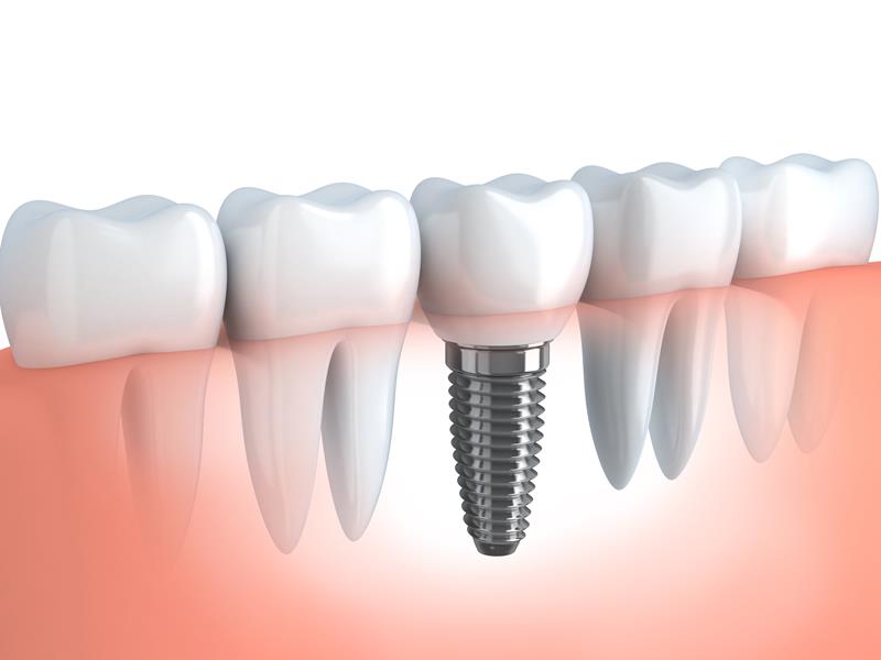 Dental Implants  Glenview, IL 